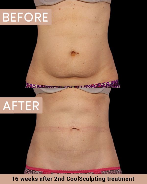 CoolSculpting St Petersburg